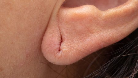 Zayıflama iğnesi oldu, kulakları değişti! Çabucak doktora başvurdu ancak…